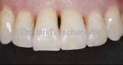 Zahnfleischrückgang nach Parodontose-Behandlung