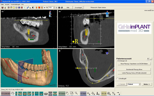 CeHa-imPLANT 3D-Planungssystem für Zahnarzt und Zahntechniker