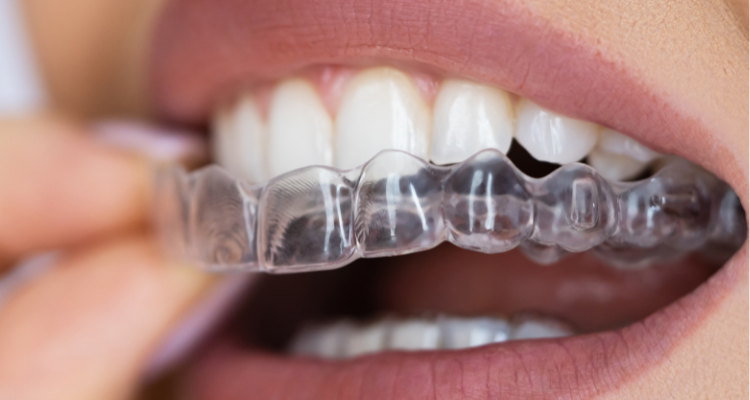 Zahnästhetik mit Alignern